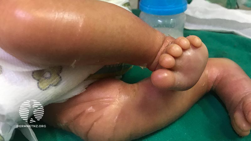 Клинический случай: Newborn encased in a shiny membrane