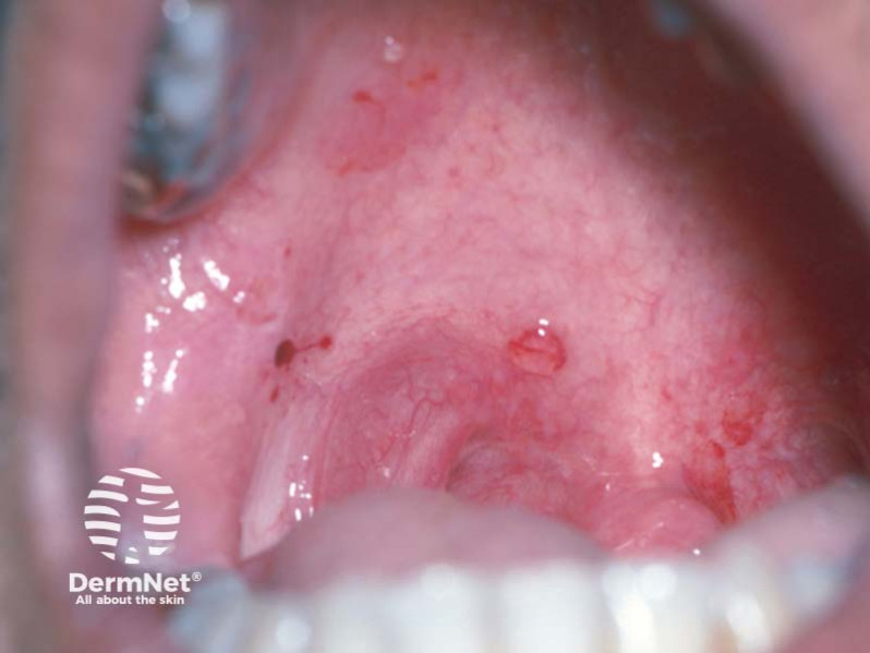 Эрозии слизистой оболочки полости рта и появление свежих пузырей на коже