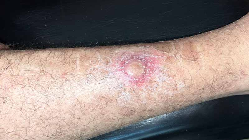 Клинический случай: Rapidly evolving disseminated skin lumps