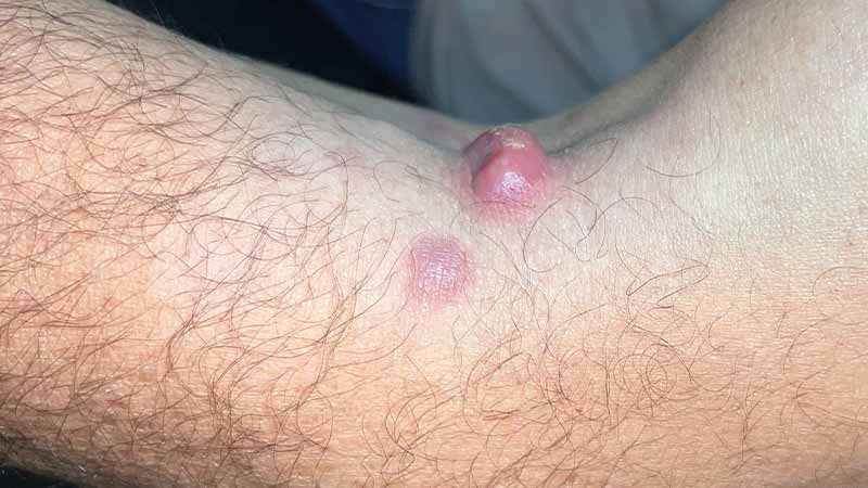 Клинический случай: Rapidly evolving disseminated skin lumps