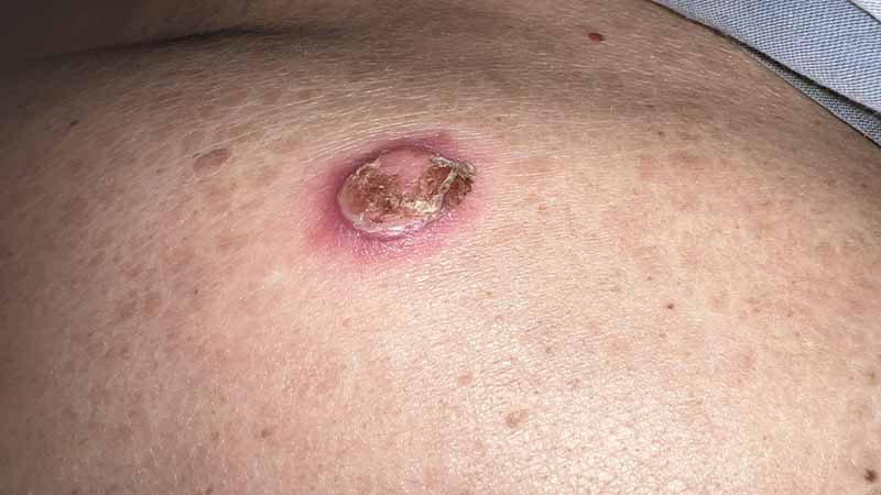 Клинический случай: Rapidly evolving disseminated skin lumps