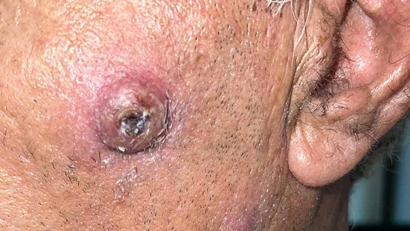 Клинический случай: Rapidly evolving disseminated skin lumps
