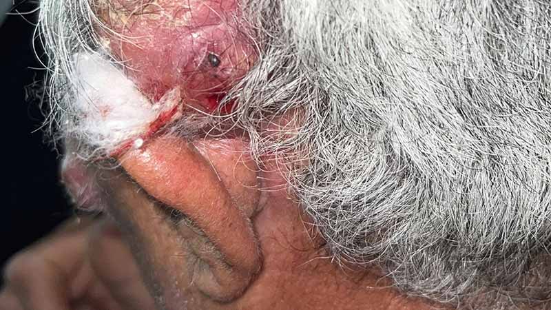 Клинический случай: Rapidly evolving disseminated skin lumps