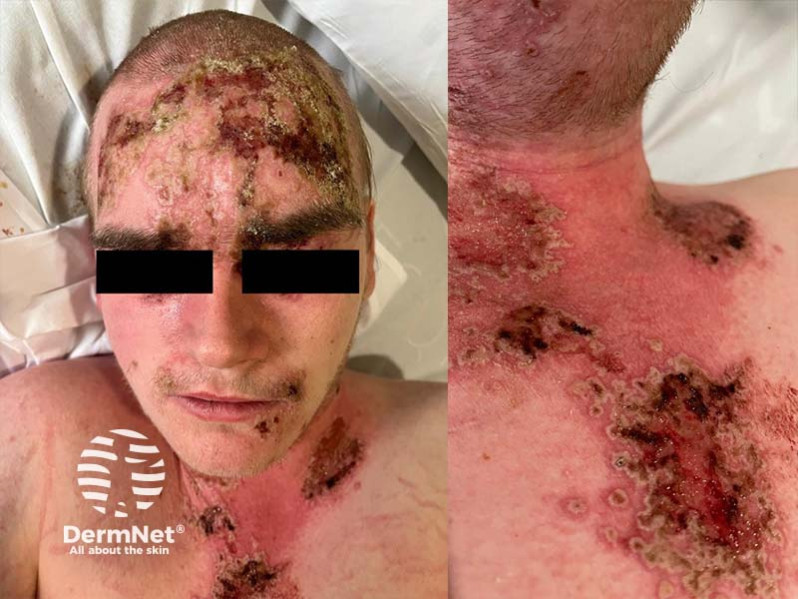 Везикулезные высыпания и лихорадка у пациента с болезнью Дарье