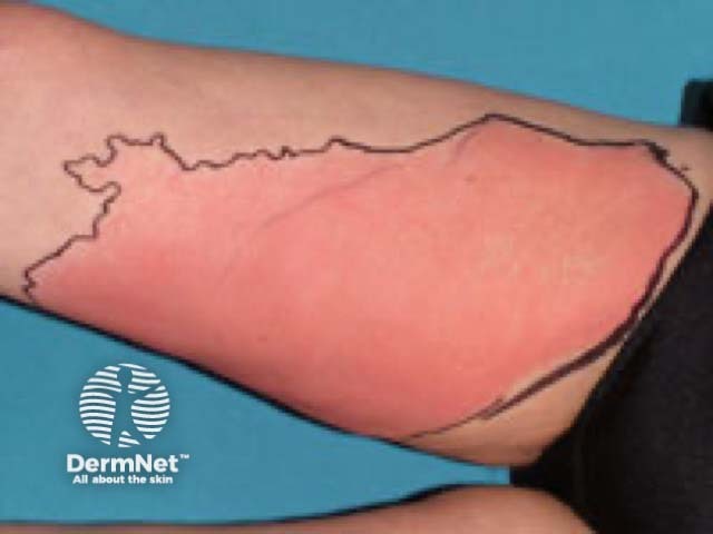 Флегмона голени после внутрикожных инъекций («skin popping»)