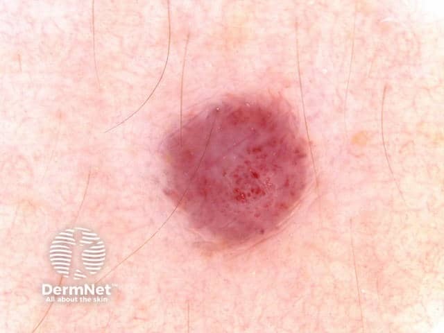 Дерматоскопия вишневой ангиомы