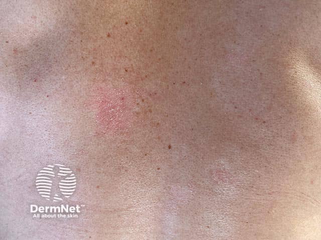 Ранние поверхностные бляшки псориаза на спине: легкое поскабливание усиливает типичное серебристо-белое шелушение (феномен стеаринового пятна)