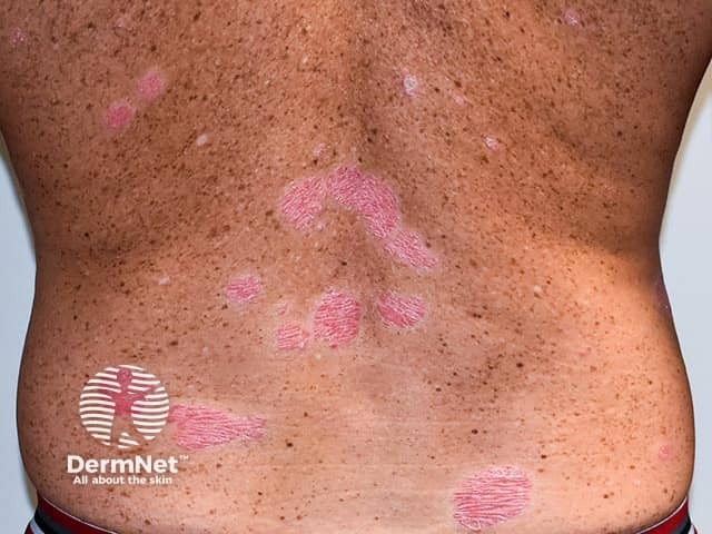 Четко отграниченные псориатические очаги на туловище; шелушение у данного пациента минимально
