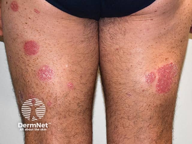 Четко отграниченные псориатические бляшки на нижних конечностях