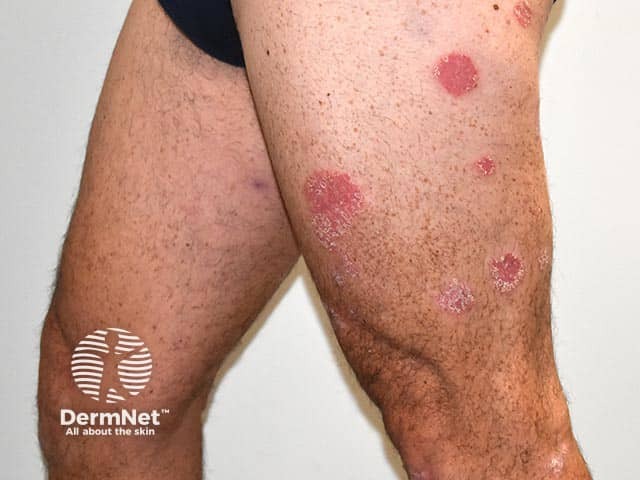 Четко отграниченные псориатические бляшки на нижних конечностях