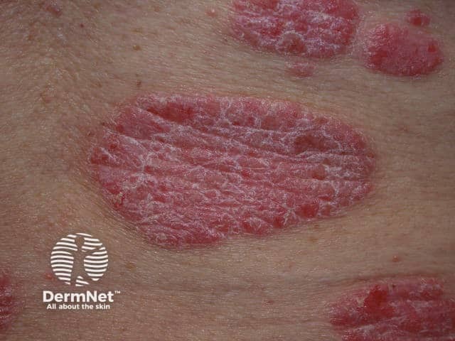 Крупный план: четко отграниченные бляшки с серебристо-белыми чешуйками при хроническом бляшечном псориазе
