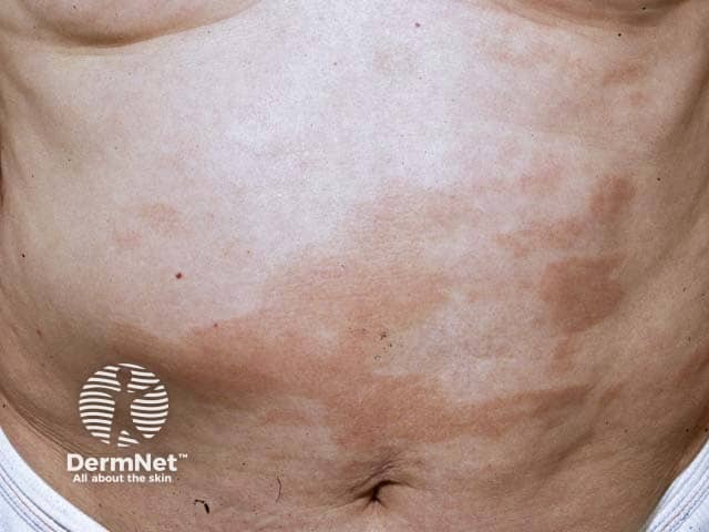 Полиморфные пятна с поверхностным шелушением при хроническом поверхностном шелушащемся дерматите