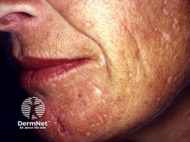 Экскориированные акне (acne excoriée)