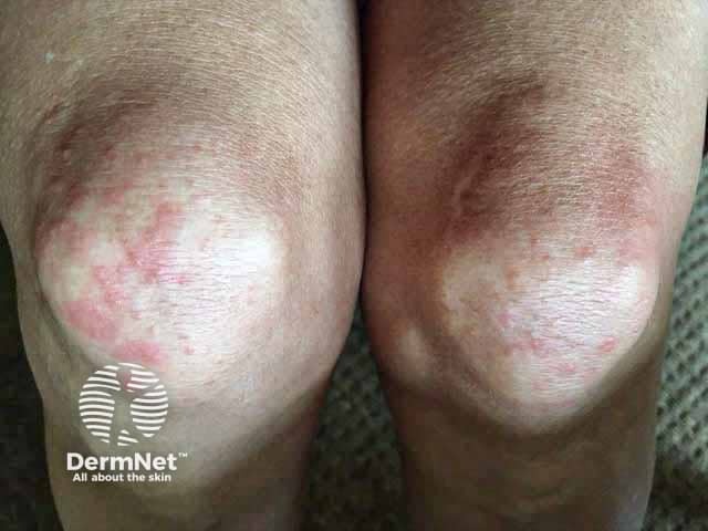 Везикулезные высыпания на коленях