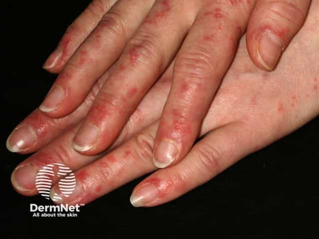 Интактность кожи над межфаланговыми суставами кистей