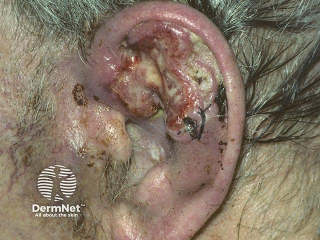 Изъязвленный плоскоклеточный рак ушной раковины; определяется увеличение предушного лимфатического узла за счет опухолевой диссеминации