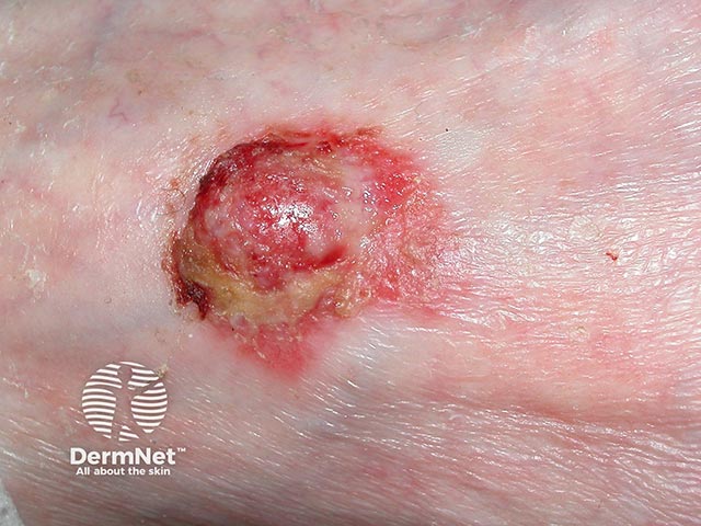 Изъязвленный геморрагический плоскоклеточный рак кожи стопы