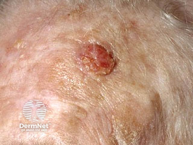 Плоскоклеточный рак кожи волосистой части головы
