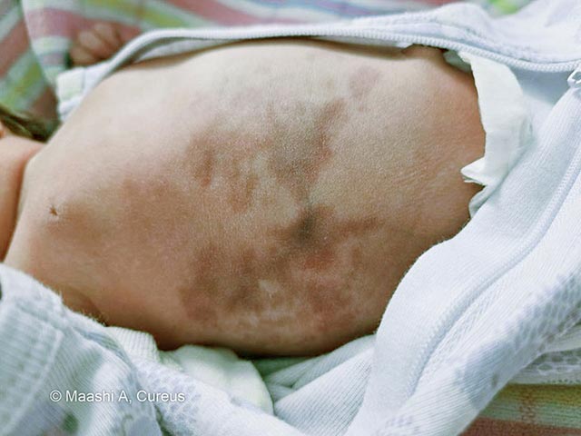 Новорожденный: распространенные сетчатые синюшно-багровые изменения кожи туловища по типу мраморности, характерные для врожденной телеангиэктатической мраморной кожи