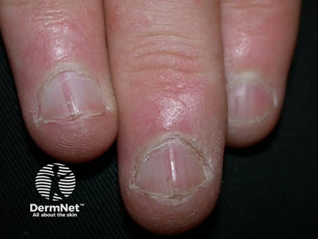V-образные вырезки свободного края и продольные красные полосы на ногтях