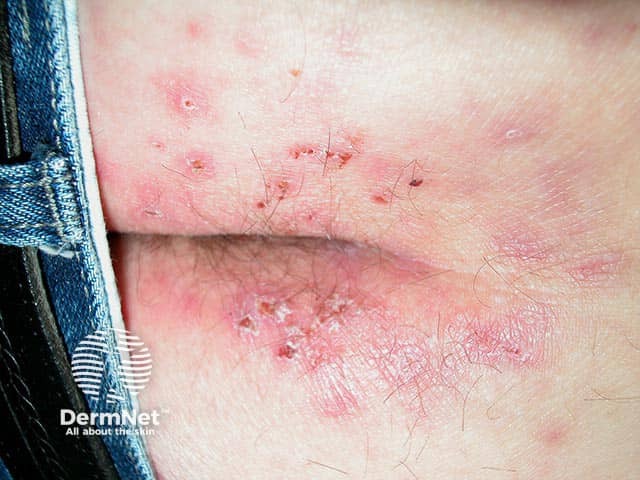 Экскориированные везикулы на ягодицах и крестце при герпетиформном дерматите (пациент 1)