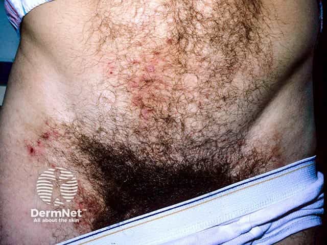 Поражение кожи живота и паховой области при герпетиформном дерматите