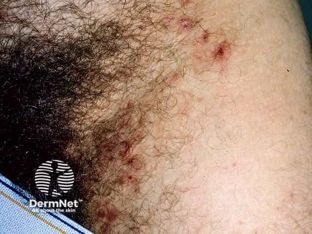 Герпетиформный дерматит с локализацией на животе и в паховой области