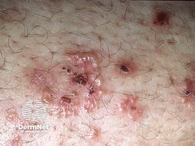 Сгруппированные везикулы на локте при герпетиформном дерматите