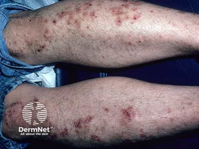 Кольцевидные высыпания с периферическими везикулами при герпетиформном дерматите
