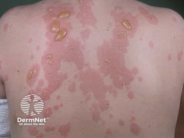 Уртикарная эритема с напряженными пузырями на ее поверхности при герпетиформном дерматите