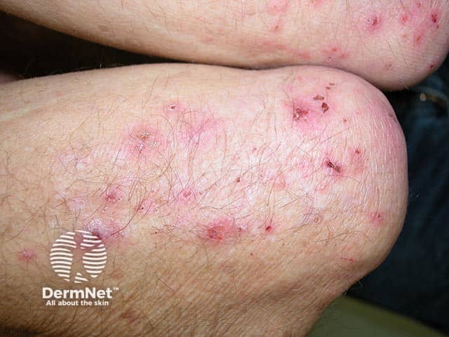 Экскориированные везикулы на коже локтей при герпетиформном дерматите