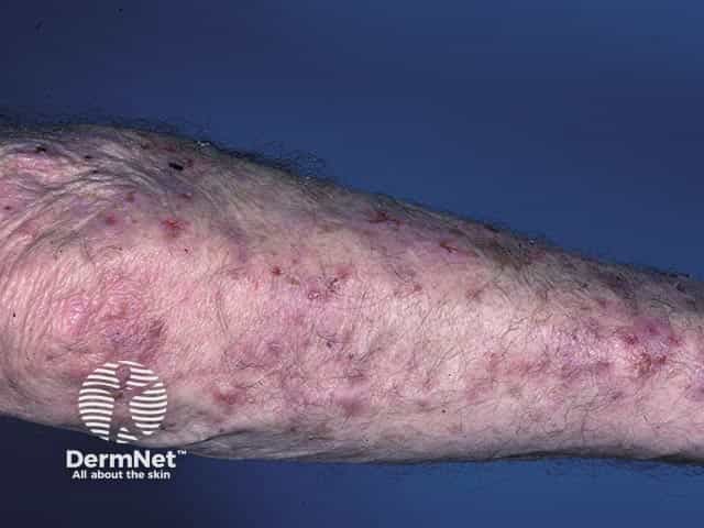 Экскориированные бляшки при герпетиформном дерматите