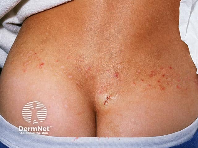 Экскориации и рубцовые изменения на коже бедер и крестца при герпетиформном дерматите