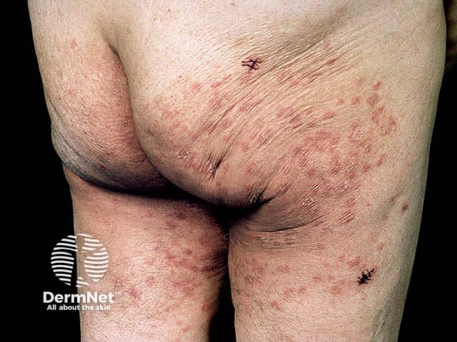 Герпетиформный дерматит с локализацией на коже тазового пояса и ягодиц