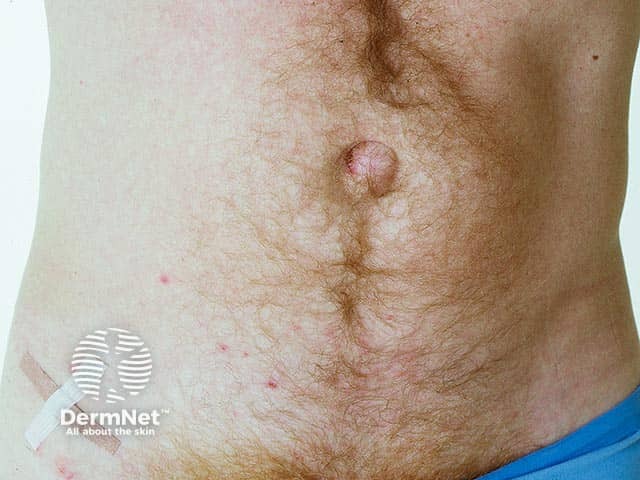 Рассеянные экскориированные папулы внизу живота при герпетиформном дерматите