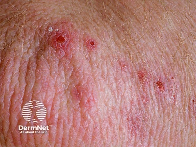 Герпетиформный дерматит в области локтевого сустава
