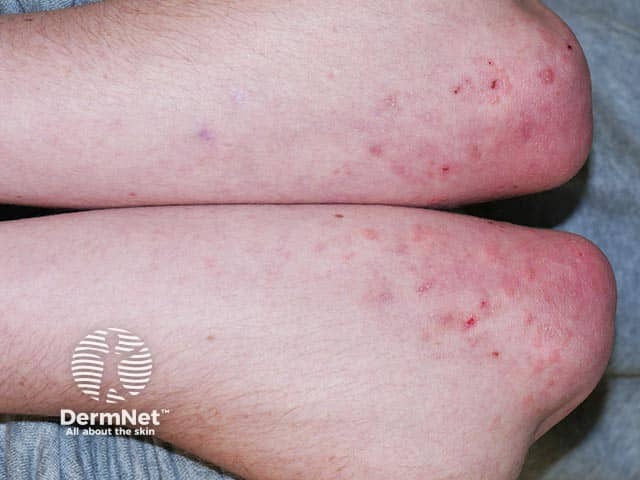 Очаги поражения на локтях при герпетиформном дерматите
