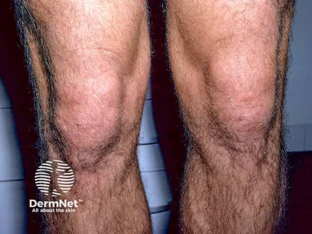Элементы сыпи на коже колена при герпетиформном дерматите