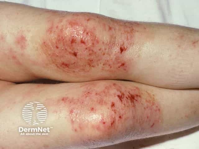 Экскориированная острая экзема на разгибательных поверхностях коленных суставов (инвертный тип)