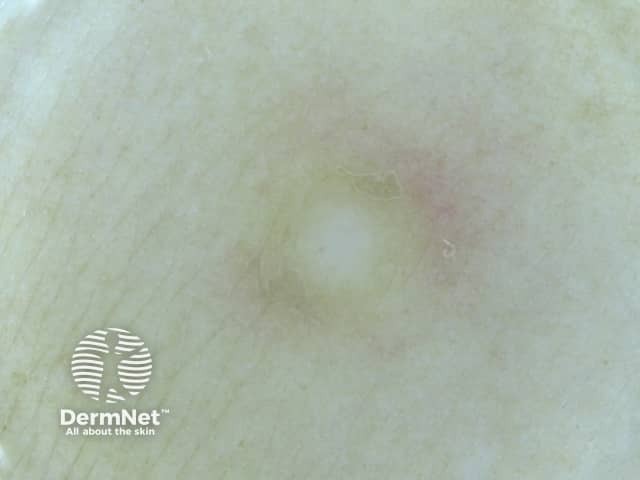 Дерматоскопия дерматофибромы