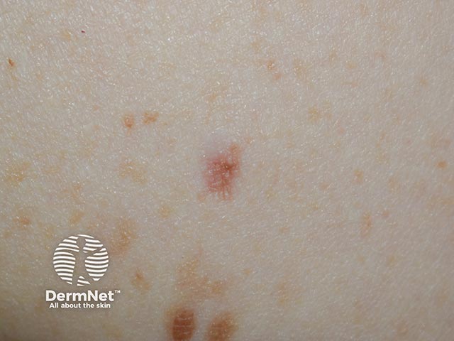 Дерматофиброма в области плечевого сустава: элементы часто гиперпигментированы и «уходят» вглубь кожи; эффект усиливается при сжатии с боков (симптом щипка)