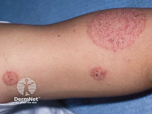 Рассеянные очаги дискоидной экземы на ноге