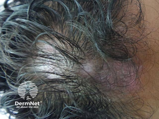 Клиническая картина у мужчины: эритематозная бляшка в лобной области