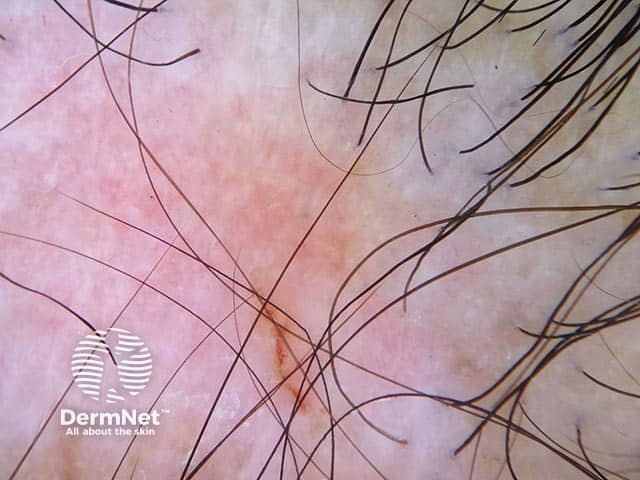 Рубцовая алопеция с утратой фолликулярных устьев, склерозом и телеангиэктазиями при дискоидной красной волчанке