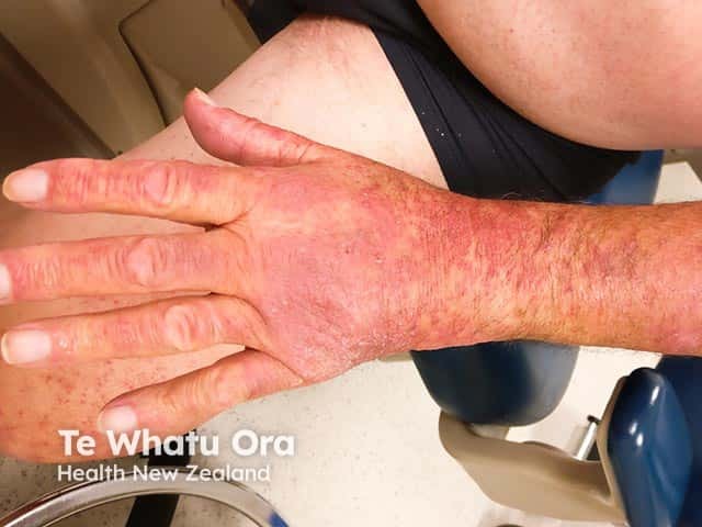 Фототоксическая реакция на доксициклин: отсутствие поражения боковых поверхностей пальцев