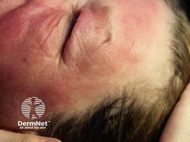 Лекарственная фотосенсибилизация на лице: интактный участок кожи под челкой
