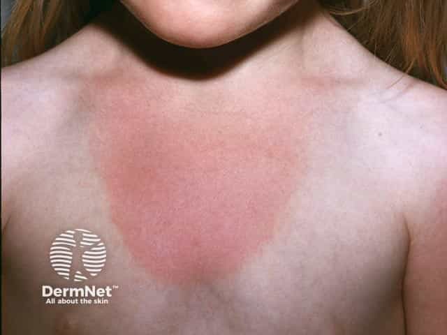 Реакция фотосенсибилизации на налидиксовую кислоту: четкая граница поражения в области выреза воротника