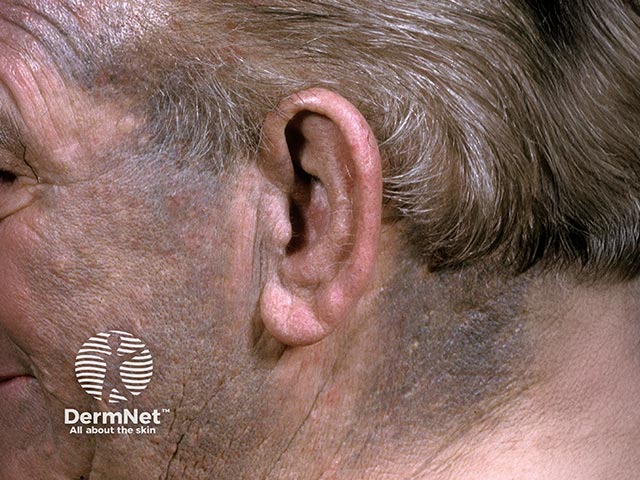 Пигментация кожи лица, вызванная миноциклином, применявшимся для лечения розацеа