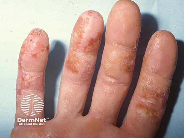 Везикулезная экзема на ладонной поверхности пальцев