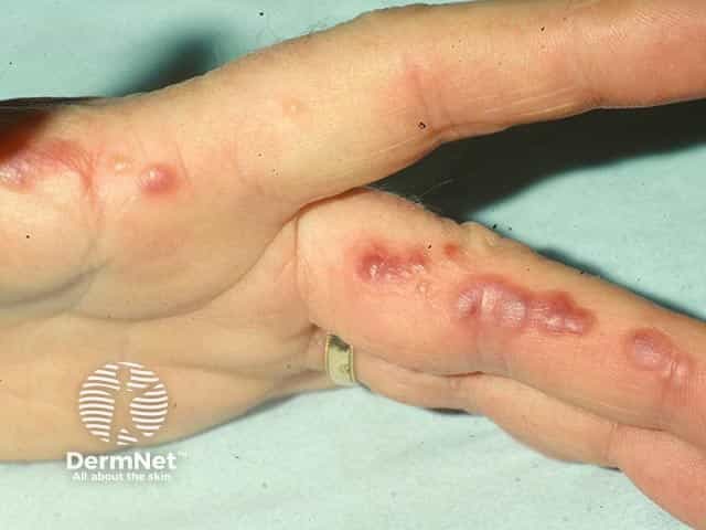 Везикулезная экзема на боковых поверхностях пальцев